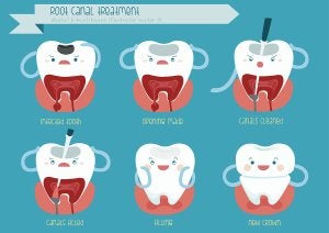 root canal schaumburg